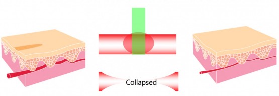 Principles of laser treatment of vascular lesions