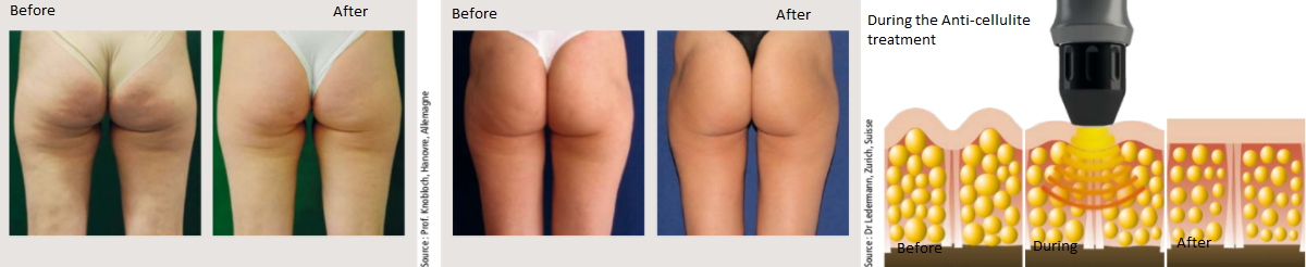 Anti cellulite treament with D ACTOR