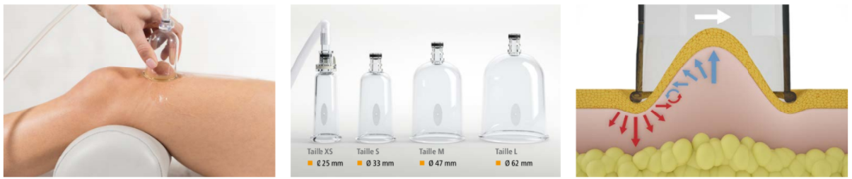 VACU-ACTOR Applicator