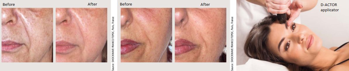 D-ACTOR Applicator on wrinkles